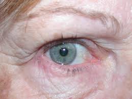 who is affected by blepharitis