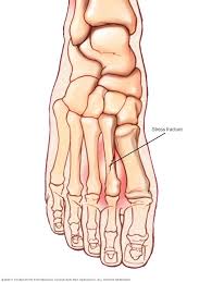 Image result for free images stress fracture of the second metatarsal in the foot.