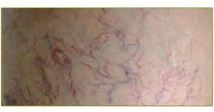 My Patient Has Visible Signs Of Spider Veins Ceap Chart