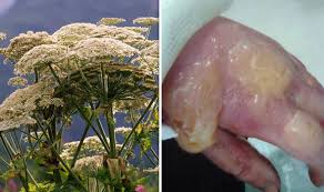 Giant Hogweed Warning Everything You Need To Know About Britains
