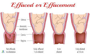 Effaced Or Effacement How To Measure Cervical Effacement