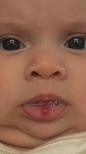 lip hemangioma babycenter