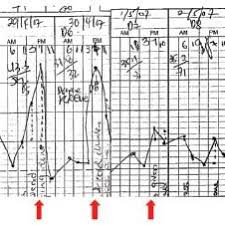 Patients Temperature Chart Showing Fever Spikes 24 H Apart