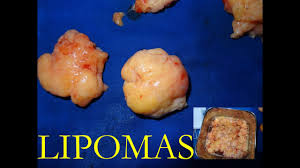 lipoma removal single eminetra