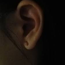 my earlobe has a large hard lump photo