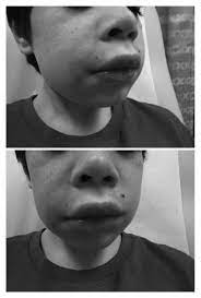 an 11 year old male with a swollen lip