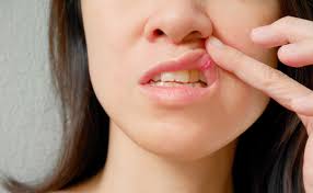 mouth ulcers why we get them and how