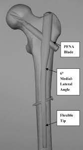 the ao asif proximal fem nail