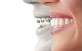 Braces Vs Invisalign By Dr Emmy Le Emmy Le Dds