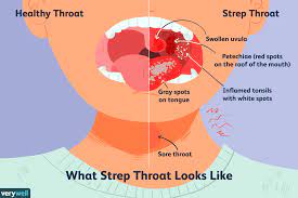 strep throat causes symptoms