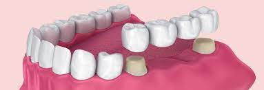 dental bridge cost tooth