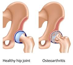 Hip Osteoarthritis