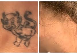 laser tattoo removal new london ink