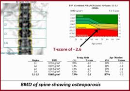 bone mineral density testing bmd