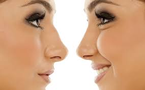 your nose without a rhinoplasty