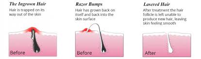 laser hair removal acne scar