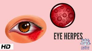 eye herpes causes signs and symptoms