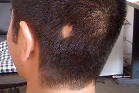 NES Clinic - ##Үүрэлсэн үс уналт- ##alopecia areata: Насанд хүрэгсэд болоод  хүүхдэд аль алинд нь тохиолдох ба дугуйрсан үс уналт гэх нь ч бий.  Шалтгаан, эмгэг жам: 1. Аутоиммуны өвчин тэр дундаа