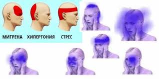 Защо се появява главоболие при остеохондроза и какво е лечението? Silno Glavobolie Prichini I Lechenie Pulsirasho I Tenzionno Lekar Bg