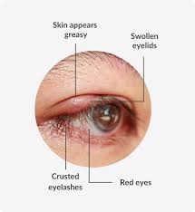 blepharitis symptoms causes and