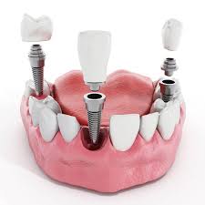 dental implantation russian dentist