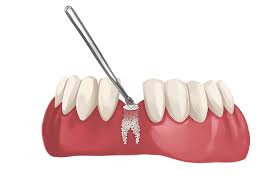 Dental Bone Grafts