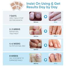 toenail f ngus treatment 32pcs nail