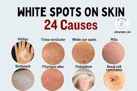 white spots on skin 24 causes