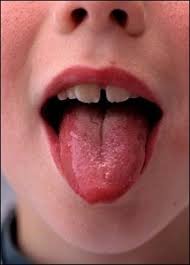 Ayurvedic Tongue Analysis What Does Your Tongue Say About