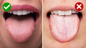 5 things a white tongue may reveal
