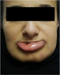 swelling of the lower lip and chin