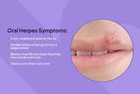 herpes signs and symptoms