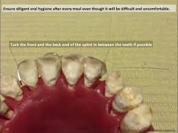 To deal with a loose tooth, improve your dental hygiene by brushing your teeth twice daily. Am Guide To Dental Trauma Adventure Medic