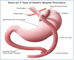 stomach pain after bariatric surgery