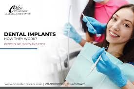 dental implants how they work
