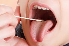 white spots on tonsils causes and
