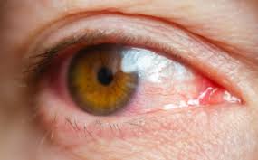 what causes eye infections b