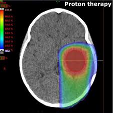 is proton therapy the silver bullet for