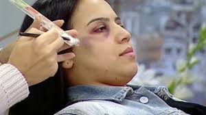 domestic violence bruises with makeup