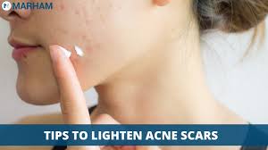 how to get rid of acne scars for good