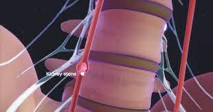 Kidney pain and back pain can be difficult to distinguish, but kidney pain is usually deeper and higher in the and back located under the ribs while the muscle. Good News Are The Kidneys Located Inside Of The Rib Cage Are The Kidneys Located Inside Of The Rib Cage Kidney Pain And Location Stones And Vs Back