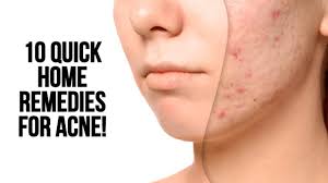 10 quick home remes for acne you