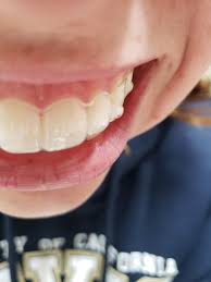 A gap between front teeth may not give you a good look. Gap Between Top Of Tooth And Tray Invisalign