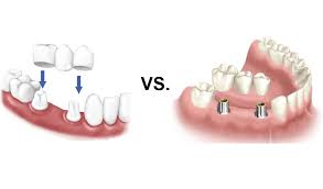 dental bridges vs implants comparison