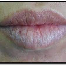 appearance of the lips at 15 days of