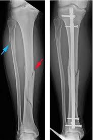 spiral fracture definition causes