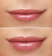 lip fillers canary wharf london