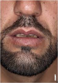 persistent lip enlargement an unusual