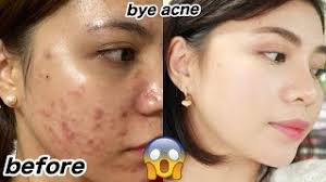 skin care routine for oily acne e