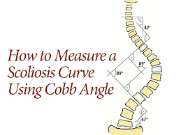 How Scoliosis Is Measured By The Cobb Angle